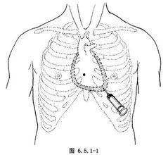 心包穿刺置管术视频,心包穿刺置管术操作步骤与要点解析